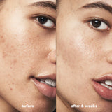 Mini Blemish Breakthrough Control Basics Kit para piel con tendencia a acné - e.l.f.