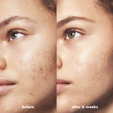 Mini Blemish Breakthrough Control Basics Kit para piel con tendencia a acné - e.l.f.